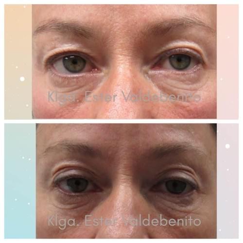 Fibroblast