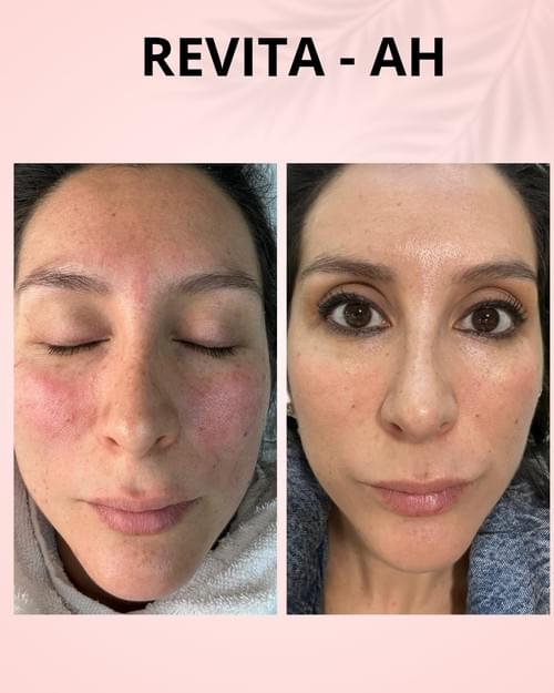 Microneedling Dermapen